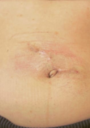 Tattoo Removal – Case 2 2024
