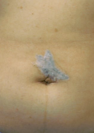 Tattoo Removal – Case 2 2024