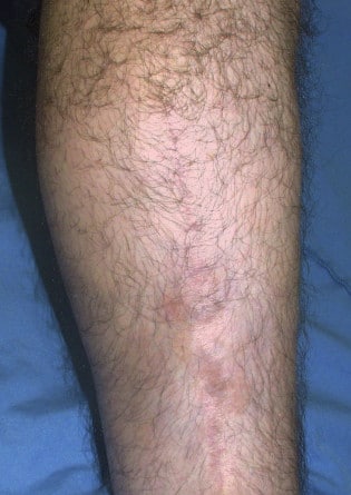 Tattoo Removal – Case 3 2024