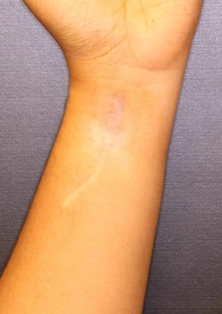 Tattoo Removal – Case 4 2024