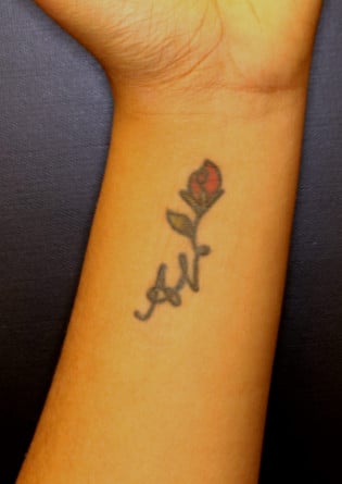 Tattoo Removal – Case 4 2024