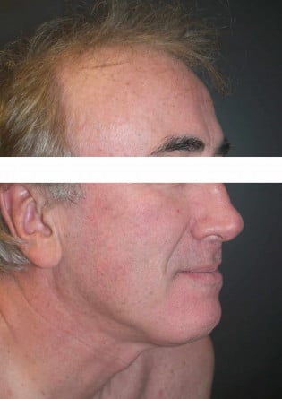 Liposuction – Neck – Case 1 2024