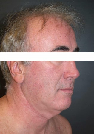 Liposuction – Neck – Case 1 2024