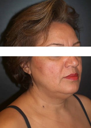Liposuction – Neck – Case 2 2024