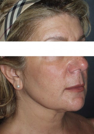 Liposuction – Neck – Case 3 2024