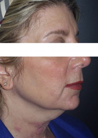 Liposuction – Neck – Case 3 2024