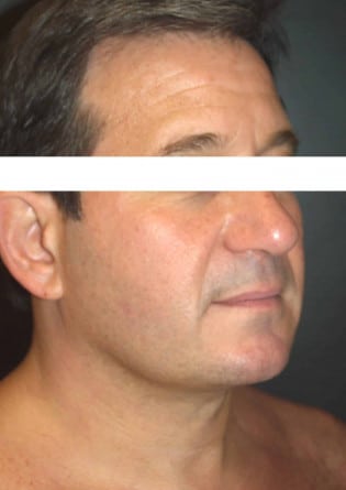Liposuction – Neck – Case 4 2024
