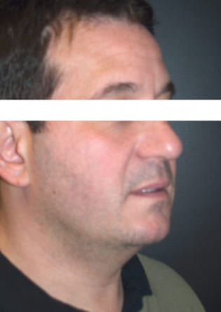 Liposuction – Neck – Case 4 2024