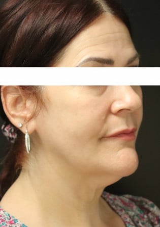 Liposuction – Neck – Case 5 2024