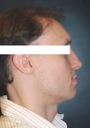 Rhinoplasty – Case 11 2024