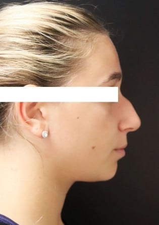 Rhinoplasty – Case 12 2024