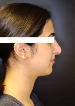 Rhinoplasty – Case 14 2024