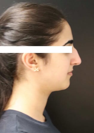 Rhinoplasty – Case 14 2024