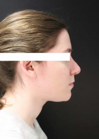 Rhinoplasty – Case 15 2024