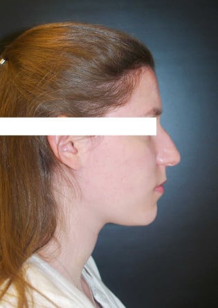 Rhinoplasty – Case 15 2024