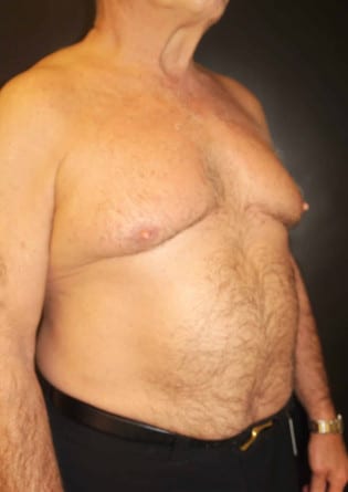 Gynecomastia- Case 1 2024