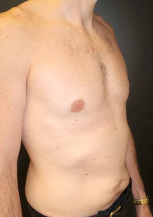 Gynecomastia- Case 2 2024