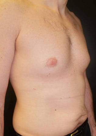 Gynecomastia- Case 2 2024