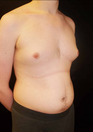 Gynecomastia- Case 3 2024