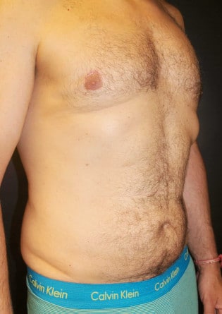 Gynecomastia- Case 4 2024