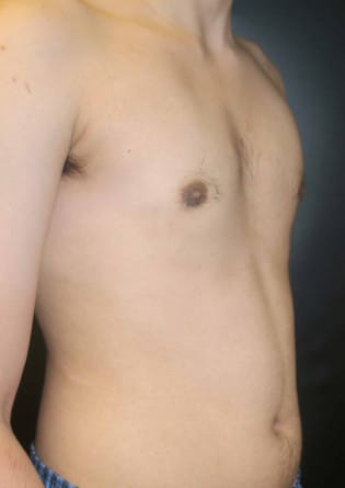Gynecomastia- Case 5 2024