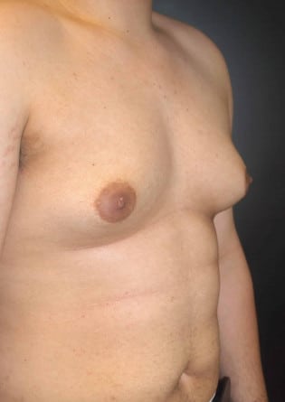 Gynecomastia- Case 6 2024