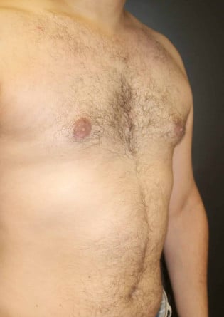 Gynecomastia- Case 7 2024