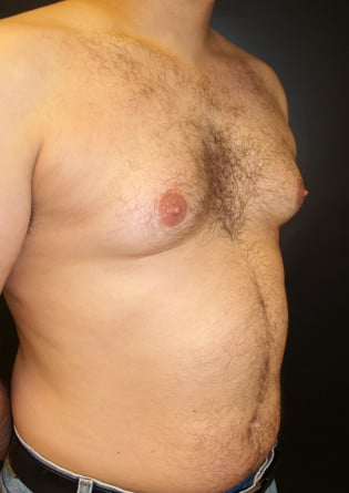 Gynecomastia- Case 7 2024