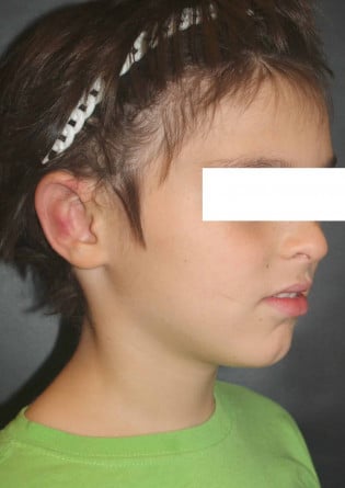 Otoplasty – Case 1 2024
