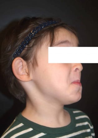 Otoplasty – Case 1 2024