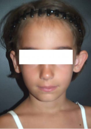 Otoplasty – Case 2 2024