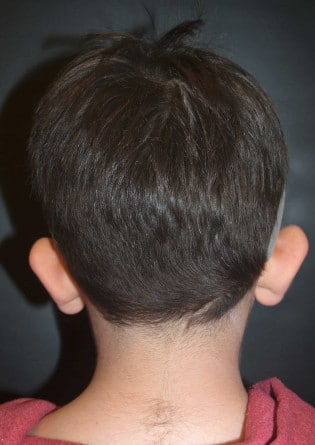 Otoplasty – Case 4 2024