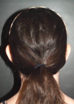 Otoplasty – Case 5 2024