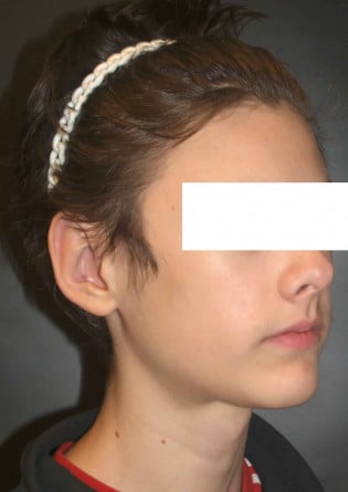 Otoplasty – Case 6 2024