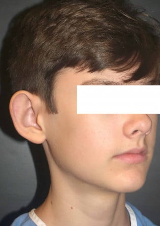 Otoplasty – Case 6 2024