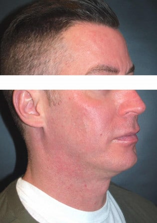 Genioplasty – Case 2 2024