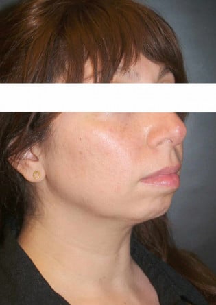 Genioplasty – Case 3 2024