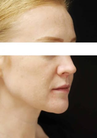Genioplasty – Case 4 2024