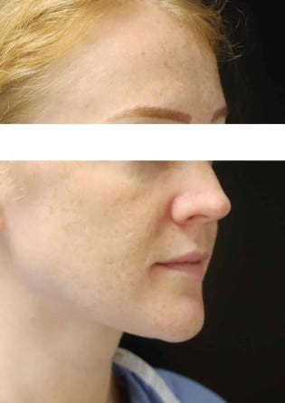 Genioplasty – Case 4 2024