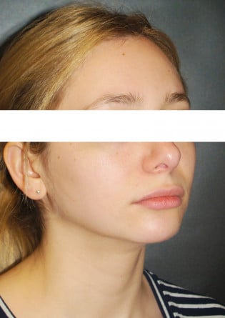 Genioplasty – Case 5 2024