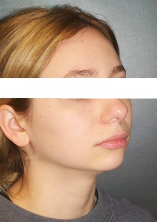Genioplasty – Case 5 2024