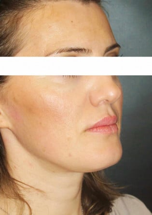Genioplasty – Case 6 2024