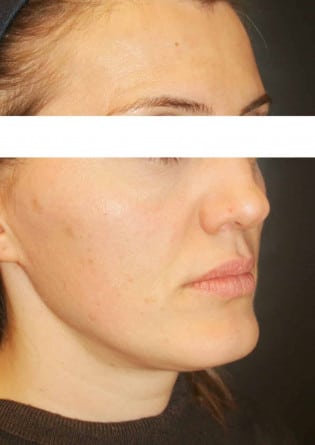Genioplasty – Case 6 2024