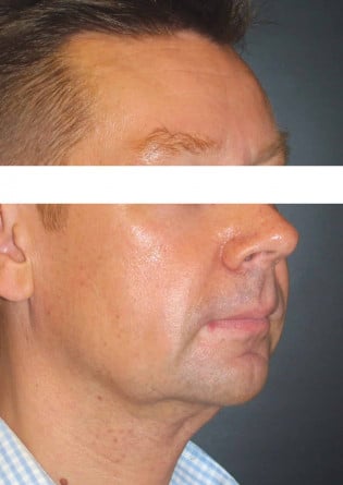 Genioplasty – Case 7 2024