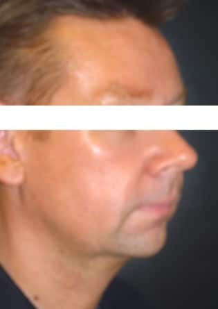 Genioplasty – Case 7 2024