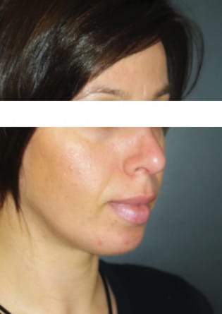 Genioplasty – Case 8 2024