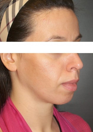Genioplasty – Case 8 2024