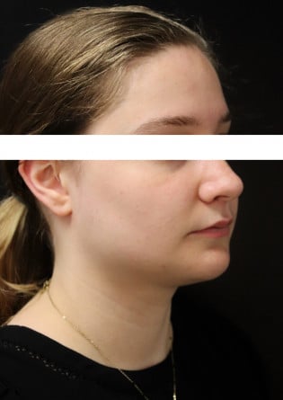 Genioplasty – Case 9 2024