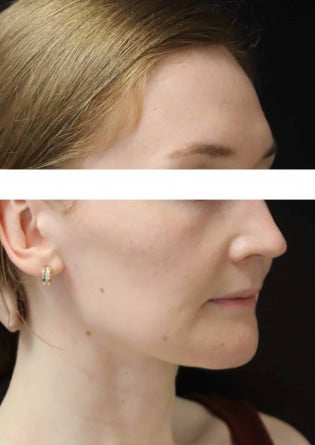 Genioplasty – Case 10 2024