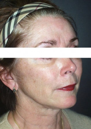 Face Lift – Case 1 2024